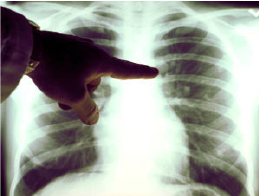 akciğer grafisi